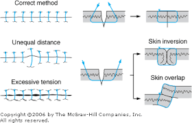 Image result for simple continuous suture pattern