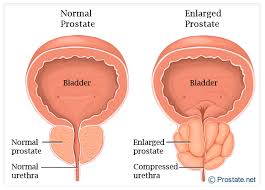 Image result for PROSTATE