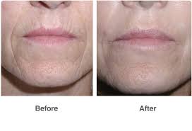 Kuvahaun tulos haulle chemical face peel before and after