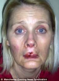 Unprovoked: Angela Gray, 44, was left permanently scarred in the unprovoked attack by 20-year-old Jade Daniels. A charity fund-raiser who was brutally ... - article-2229862-15E9A37B000005DC-423_306x423