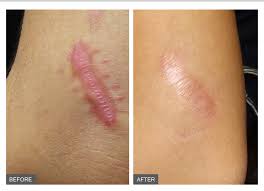 Hasil gambar untuk keloid