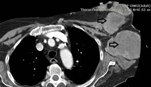 Breakthroughs in Sarcoma Research and Treatment