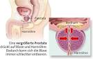 Reizblase bei Männern blase ok
