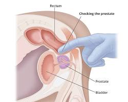 Image of Digital Rectal Exam