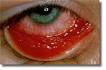 Maladie oeil - maladies yeux - glaucome - cataracte - myopie