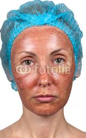 Skin condition after chemical peeling TCA. de Konstantin Kulikov, Photo libre de droits #42052904 sur Fotolia.com - 400_F_42052904_mvsexiQ7QLFsvUq9wqiOUfE2t3qg33Jg