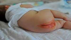 Image result for newborn diaper rash