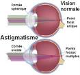 Astigmatisme - Dfinition, Causes, Symptmes