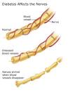 Neuropathy (Nerve Damage American Diabetes Association)