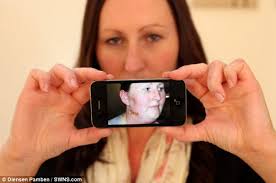 Jenny Taylor, 30, from Liverpool, suffered an horrific allergic reaction to an iPhone cover - article-2123921-126EF5F4000005DC-773_634x420