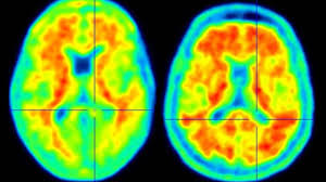 revolutionize treatment Discovery of Genetic Variant Provides Protection Against Alzheimer