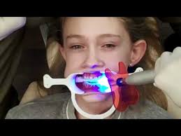 Image result for gambar braces gigi