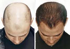 http://lutfianabeauty.blogspot.com/2011/12/obat-penumbuh-rambut-hairtonicum-spray.html