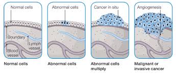 Image result for Cancer types