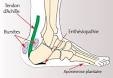 Bursite achilleenne