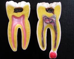 Image of tooth with a healthy pulp and an infected pulp