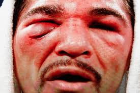 Antonio Margarito Battered by Manny Pacquiao, Right Eye Nearly Shut - antonio-margarito-eye