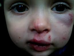 Katie Ann Guttridge, Three, Beaten Black And Blue By Two-Year-Old At Nursery - KATIE-ANN-GUTTRIDGE-1