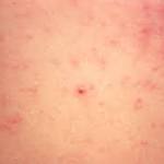  Louisiana: 2nd measles case in New Orleans