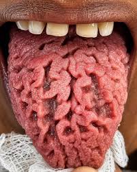 Black hairy tongue myths: debunked! Black hairy tongue may ...