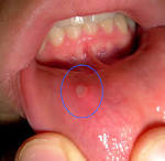 Mouth ulcers pictures