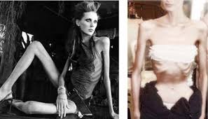 Resultado de imagen para imagenes de anorexia