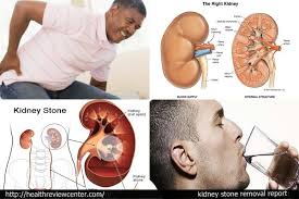 Image result for kidney stone images