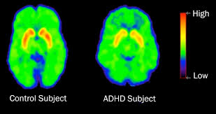 ADHD and ADD Links To Home Environment