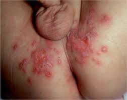 Resultado de imagem para herpes genital