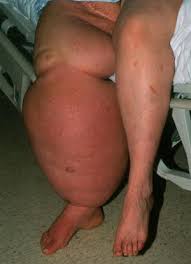 Image result for elephantiasis patient