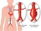 Symptome bauchaortenaneurysma