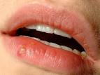 Herpes labialis (Lippenherpes) Apotheken Umschau