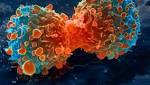  Immunotherapy-first cancer treatment a 'game-changer', say scientists