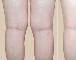 Image of Varicose veins after laser treatment