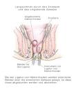 Hamorrhoiden im darm symptome