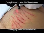 Smagliature laser frazionato