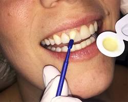 Image of Dental Fluoride Treatment