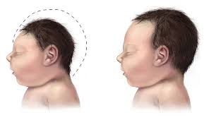 Image result for Zika virus babies