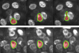 Advances in Soft Matter Physics: A Promising Tool for Assessing Malignant Tumors' Risk - 1