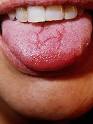 Sore Tongue and Tongue Pain (Glossodynia or Glossalgia)