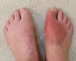 Image of Gout foot