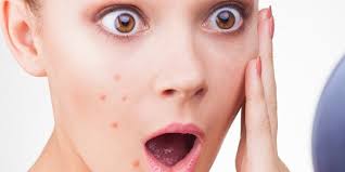 Image result for foto jerawat