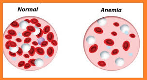 Resultado de imagen para anemia