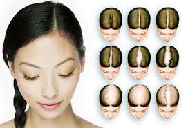 Women\u0026#39;s Hair Loss Pictures: Thinning Hair Causes, Treatments, and ... - webmd_rf_photo_of_hair_loss_chart
