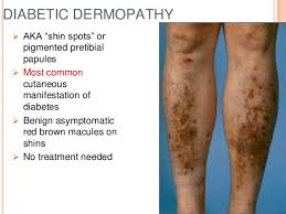 Image result for dermatopathy DM