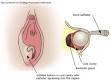 Viewer Comments and Reviews: Bartholin Cyst - Treatment - 