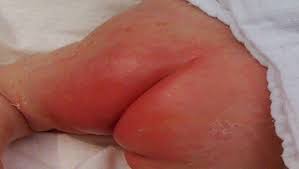 Image result for newborn diaper rash