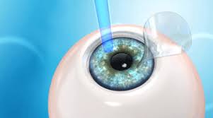 Image result for lasik