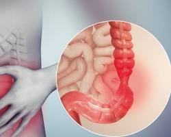 Imagen de Dolor abdominal en diverticulitis