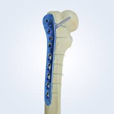 LCP Femoral Proximal Lateral Plate – Hipokrat Tıbbi Malzemeler